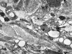M,26y. | periphery of a glial scar M,26y. | periphery of a glial scar